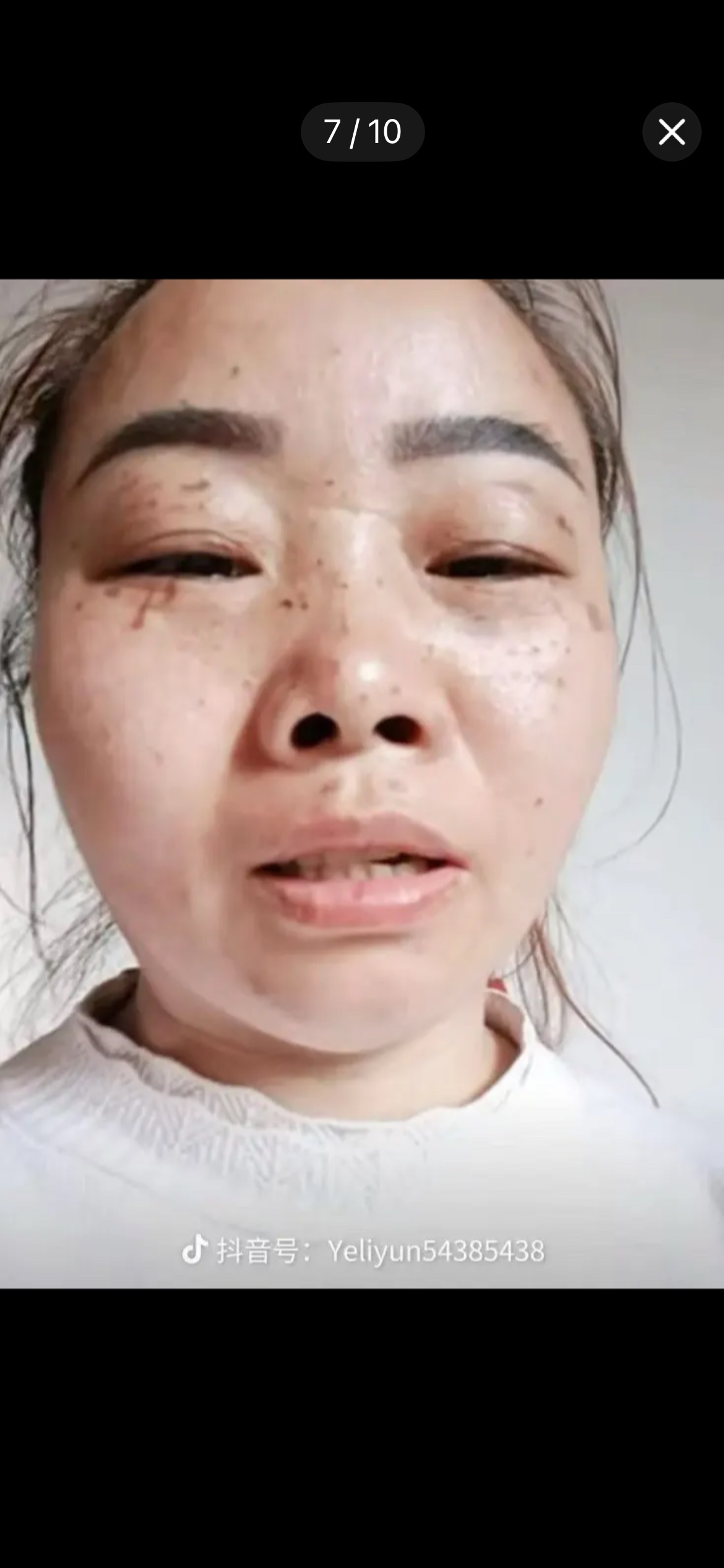 一位女性的面部特写，眼周与面颊有明显伤痕与出血点，画面下方带有一个抖音号水印